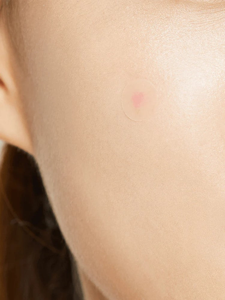 Close-up of a model's cheek with the Cosrx transparent acne patch, highlighting its discreet design for anytime use.