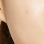 Close-up of a model's cheek with the Cosrx transparent acne patch, highlighting its discreet design for anytime use.